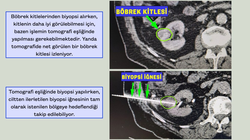 Böbrek biyopsisi